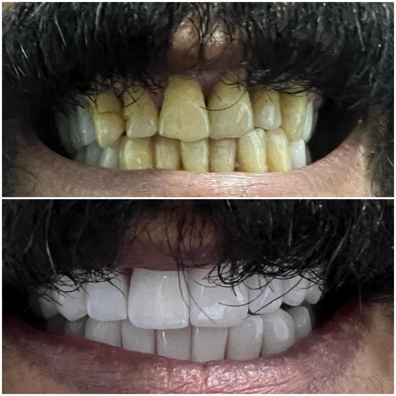Before and After Case 6
